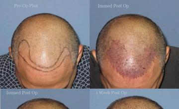 Top view - Before and after surgical hair replacement