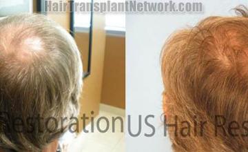 Back / Crown results from hair restoration operation