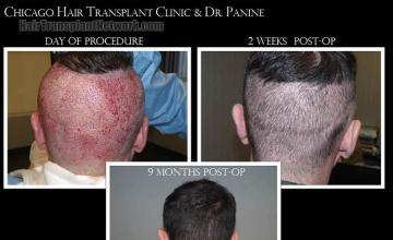 Hair restoration procedure before and after pictures