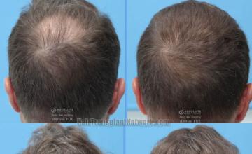 Hair replacement surgery before and after images