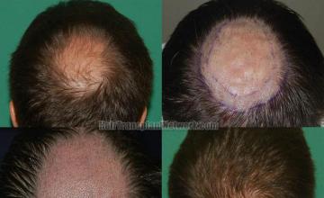 Hair transplantation surgery before and after images