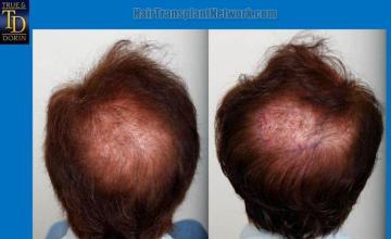 Hair restoration procedure before and after pictures