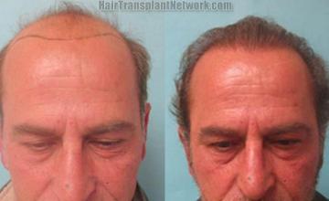 Hair restoration procedure before and after results