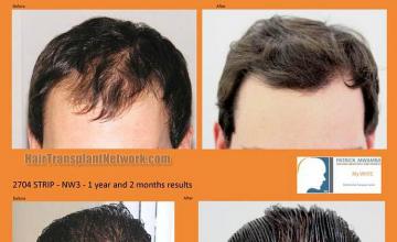 Hair restoration procedure before and after results