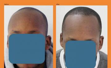 Hair restoration procedure before and after results