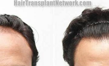 Hair restoration procedure before and after results