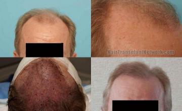 Hair restoration procedure before and after results