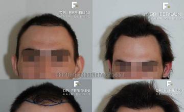 Before and after hair transplantation result photographs