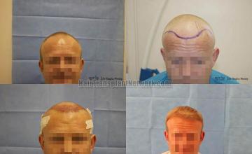 Hair transplantation surgery before and after images