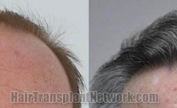 Hair restoration procedure before and after results