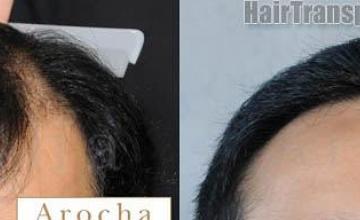 Before and after hair transplantation result photographs