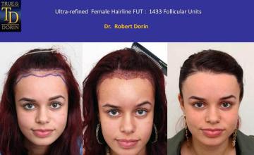 Before and after hair transplant procedure images