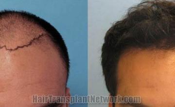 Hair restoration procedure before and after results