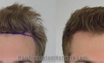 Hair restoration procedure before and after results