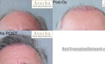 Hair transplantation surgery before and after pictures