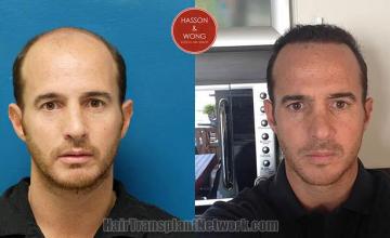 Hair restoration procedure before and after results