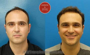 Before and after hair transplant procedure images