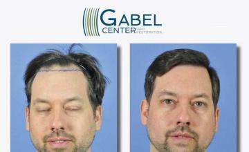 Hair restoration procedure before and after results