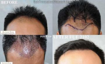 Hair restoration procedure before and after results