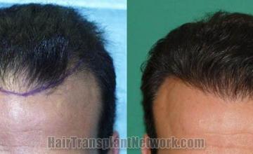 Hair restoration procedure before and after results