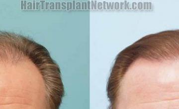 Before and after hair transplantation result photographs