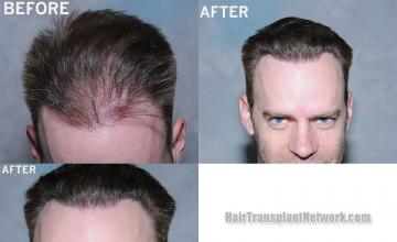 Hair restoration procedure before and after results