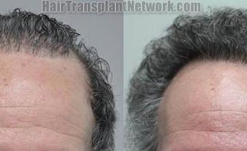 Hair restoration procedure before and after results