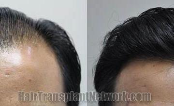 Hair restoration procedure before and after results