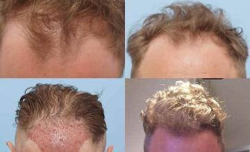 Hair restoration procedure before and after results