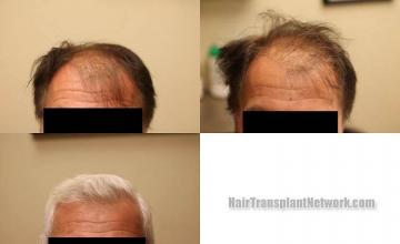 Front view - Before and after hair transplantation surgery