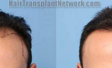 Front view - Before and after hair transplantation surgery