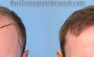 Front View - Before and after hair transplantation surgery