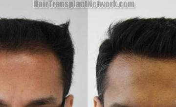 Front view - Before and after hair restoration procedure