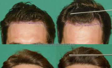 Front view - Before and after hair restoration procedure