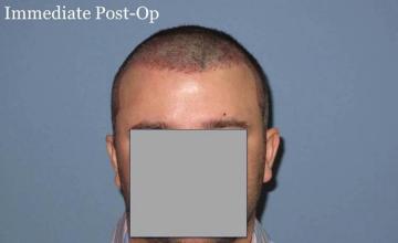 Hair restoration procedure results