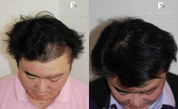 After hair transplant photos shown from the top