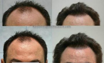 Front view - Before and after hair transplantation