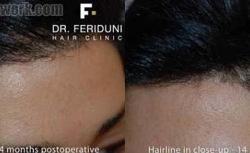 Hair transplant surgery before and after images