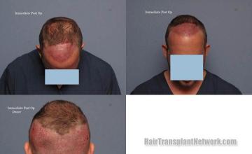 Hair restoration procedure before and after pictures