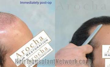 Hair transplantation surgery before and after images