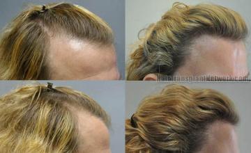 Hair transplantation surgery before and after photos