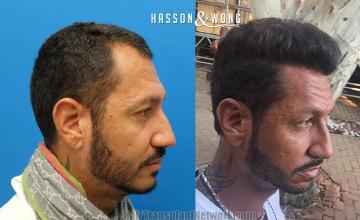 Hair transplantation surgery before and after images