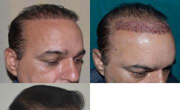 Hair transplantation surgery before and after photos