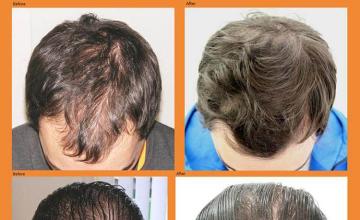 Hair transplantation surgery before and after photos