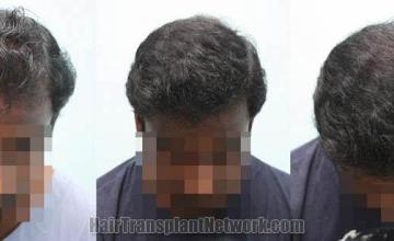 Hair transplantation surgery before and after photos,