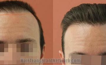 Hair restoration procedure before and after results