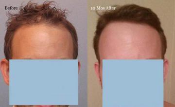 Hair restoration procedure before and after results