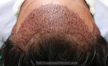 Surgical hair transplantation result photographs