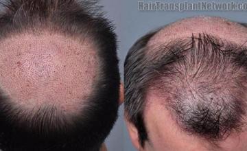 Hair restoration surgery before and after photos