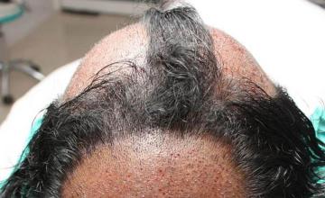 Hair restoration surgery before and after photos